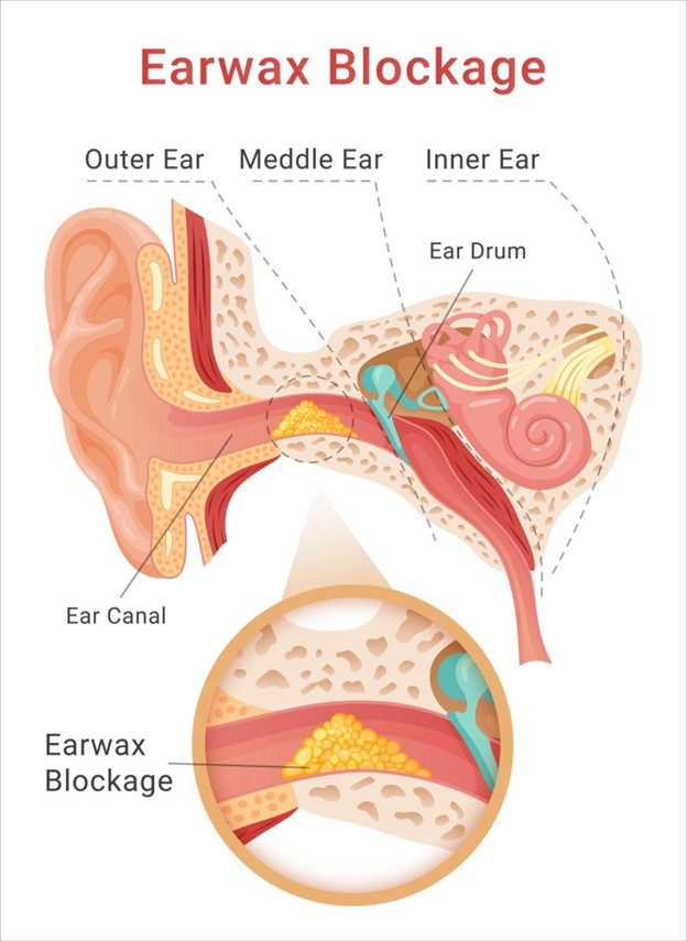 Earwax Blockage